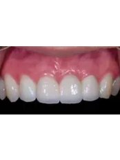 Dental Implants - Natural Dental Center