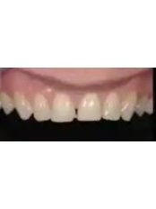 Porcelain Veneers - Natural Dental Center