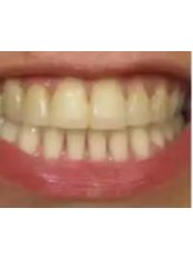 Zoom! Teeth Whitening - Natural Dental Center