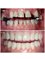 Perfect Smile Dental Implant Center - Before end After 