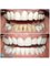 Perfect Smile Dental Implant Center - Full mouth restoration cerec crowns 