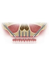 All-on-X Zygomatic Dental Implants (Upper) - Perfect Smile Dental Implant Center