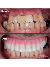 All-on-4 Dental Implants - Perio and Implants