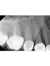 Premolar Root Canal - Revolution Dental Care