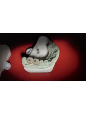 Single Implant - Revolution Dental Care