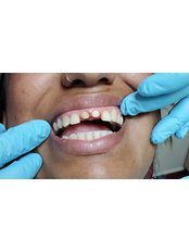 Dental Crowns - Revolution Dental Care