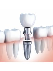 Dental Implants - Revolution Dental Care
