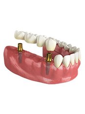 Implant Bridge - Revolution Dental Care