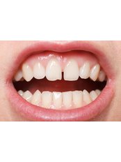 Chipped Tooth Repair - Revolution Dental Care