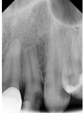 Incisor Root Canal - Revolution Dental Care