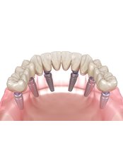 All-on-6 Dental Implants - Revolution Dental Care
