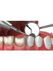 Teeth Cleaning - Revolution Dental Care