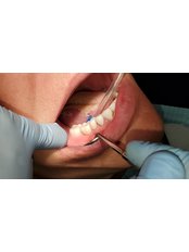 3-Unit Zirconia Bridge - Revolution Dental Care