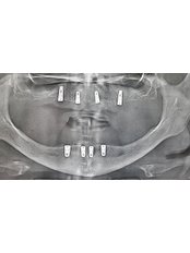 Digital Panoramic Dental X-Ray - Revolution Dental Care