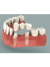 Permanent Bridge - Revolution Dental Care