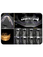 3D Dental X-Ray - Revolution Dental Care