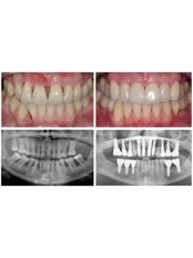 Implant Dentist Consultation - Smile 4 Less Centro