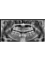 Panoramic Dental X-Ray - TEETH SAVERS DENTAL CLINIC
