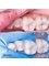 The Dental Central - Remotion of cavities for composite fillings 