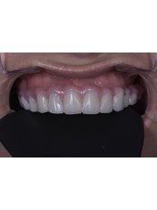 All-on-4 Dental Implants - Zenzao Smile Studio