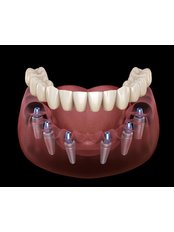 All-on-6 Dental Implants - Zenzao Smile Studio