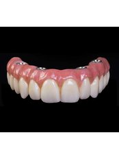 All-on-4 Dental Implants - Zenzao Smile Studio