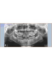 Panoramic Dental X-Ray - Dent Clínica Dental
