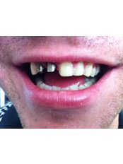 Porcelain Crown - Dent Clínica Dental