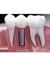 Dental Implants - Dent Clínica Dental