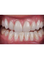 Veneers - Dent Clínica Dental