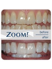 Zoom! Teeth Whitening - Dent Clínica Dental