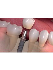 Single Implant - Dr. Llamas Dental Office