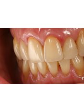 Six Month Smiles™ - Odontología Especializada