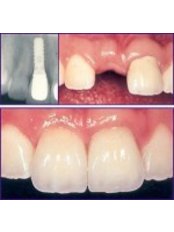 dental implant - Odontología Especializada