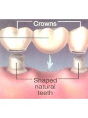 Dental Bridges - Odontología Especializada