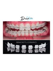Braces - Dentino