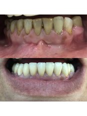 Zirconia Crown - Dental Montenegro
