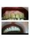 Zecevic dental - before and after by dr Zecevic 