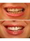 Zecevic dental - teeth whitening 