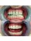 Dental Implant Center - Ceramic crowns 