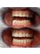 Dental Implant Center - Ceramic veneers 