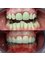 Dental Implant Center - Gum surgery, ceramic crowns and lower braces 