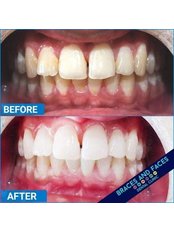 Teeth Whitening - Braces and Faces Dental Clinic