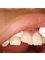 CM Dental Family Practice - Dental trauma case treated at CM Dental clinic 