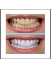 Teeth Whitening - VitalDent Managua