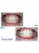 JOVE DENT DENTAL CLINIC - teeth whitening to our patient 