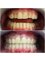 JOVE DENT DENTAL CLINIC - Non metal, circon teeth 