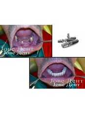 I-FIX dental implants - JOVE DENT DENTAL CLINIC
