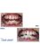 JOVE DENT DENTAL CLINIC - teeth whitening to our patient 1 