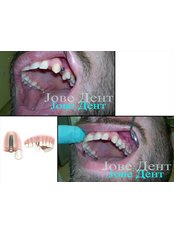 Dental implant - JOVE DENT DENTAL CLINIC
